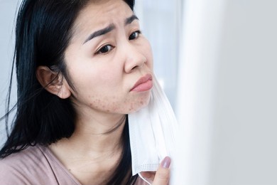 asian woman having a problem with acne and rash skin allergy under chin and face after wearing a protective mask