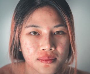 asian woman suffering from skin allergy from cosmetic and make up making her skin all over the face red itchy and painful.