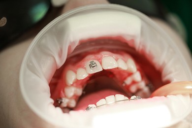 installation of braces on the upper teeth. treatment by an orthodontist. focus on braces. selective sharpness.