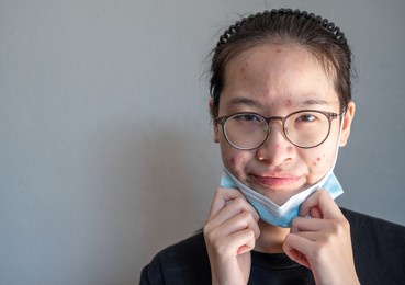 young asian woman taking off a mask for showing her face having acne inflammation. wearing mask for a longtime can actually cause a variety of skin problems.