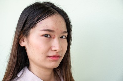 ugly asian woman with large pimple (or elephant head acne) and acne inflamed on her face. hard pimples develop when dead skin cells, sebum, and bacteria enter the skin's surface.