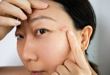 portrait of worrying asian woman with problems of acne inflammation (papule and pustule) on her face. conceptual of problems on woman skin.
