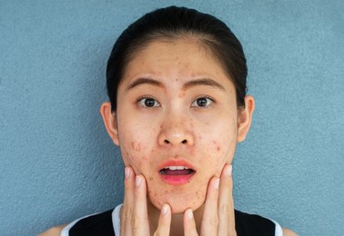 asian woman having stress because of problems of acne inflamed on her face. inflamed acne consists of swelling, redness, and pores that are deeply clogged with bacteria, oil, and dead skin cells.