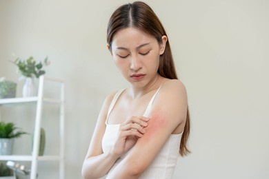 dermatology, asian young woman, girl allergy, allergic reaction from atopic, insect bites on her arm, hand in scratching itchy, itch red spot or rash of skin. healthcare, treatment of beauty.