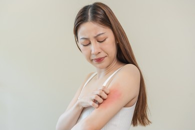 dermatology asian young woman, girl allergy, allergic reaction from atopic, insect bites on her arm, hand in scratching itchy, itch red spot or rash of skin. healthcare, treatment of beauty.