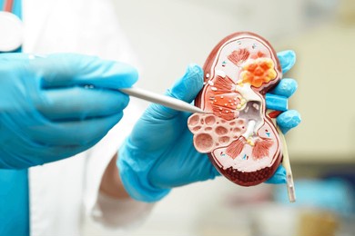 chronic kidney disease, doctor holding model for treatment urinary system, urology, estimated glomerular filtration rate egfr.