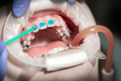 ge etching on teeth before installing braces, crooked teeth in a teenager, orthodontics, teeth alignment, treatment by a dentist - orthodontist.

