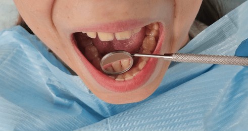 closeup of mouth during dental examination with mirror. dental treatment for children and adolescents