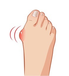 color vector foot with a painful bunion