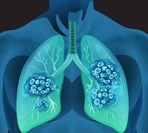 lung cancer in human body illustration