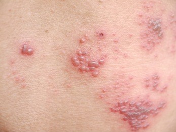 raised red bumps and blisters caused by shingles on skin
