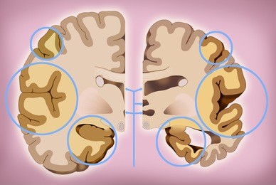 schematic illustration of human head with brain representation, two halves, one healthy and one with alzheimer's.