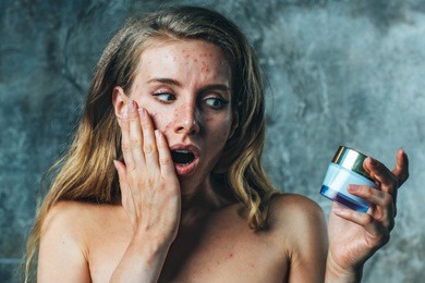 young woman have allergy on body cream. her face have a lot of acne and she is very unhappy.