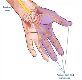 transverse carpal ligament compressed median nerve hand