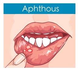  vector illustration of a woman with aphthae on lip.