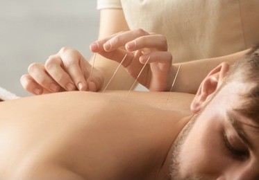 young man getting acupuncture treatment, closeup
