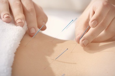young woman undergoing acupuncture treatment, closeup