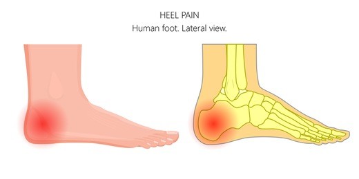 vector illustration of unhealthy human foot with pain in the heel bone. anatomy of the ankle. lateral or side view of the foot. for advertising and other medical publications. eps 10.