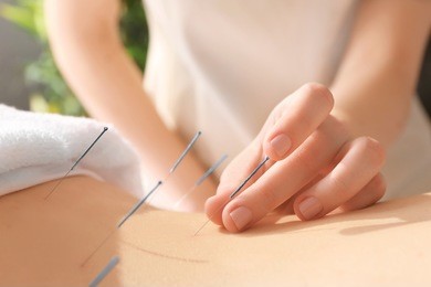 young woman undergoing acupuncture treatment, closeup