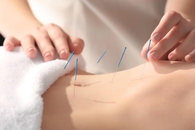young woman undergoing acupuncture treatment, closeup