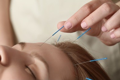 young woman undergoing acupuncture treatment, closeup