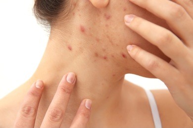 allergy concept. young woman with pimples on her face, closeup