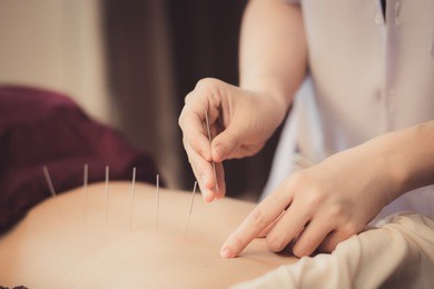 adult male physiotherapist is doing acupuncture on the back of a female patient. patient is lying down on a bed and is covered with royal blue towels.