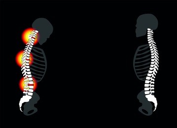 back problems, neck aches, slipped disc prolapses - curved back with severe pain and healthy back in comparison - isolated vector illustration on black background.
