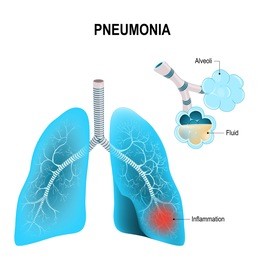 pneumonia. normal and inflammatory condition of the lung, and inflamed alveoli with fluid.