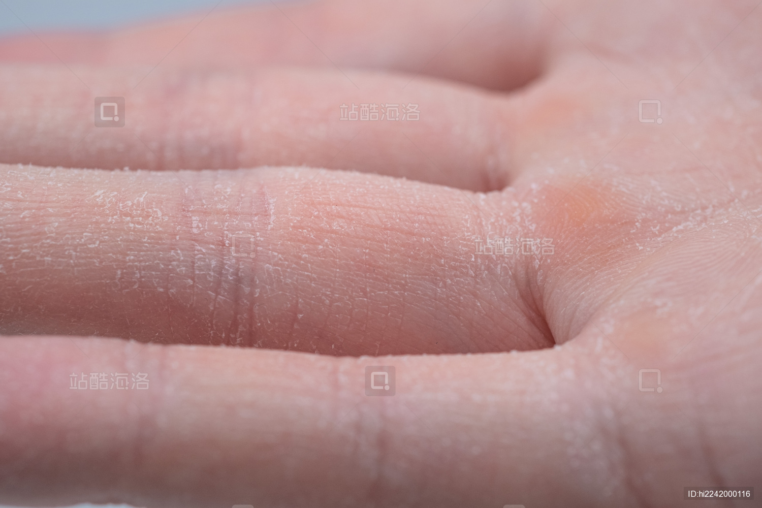 刚才发现大拇指指肚有一部分皮肤发白，看上去像是要掉皮的样子（_皮肤科_邻医网