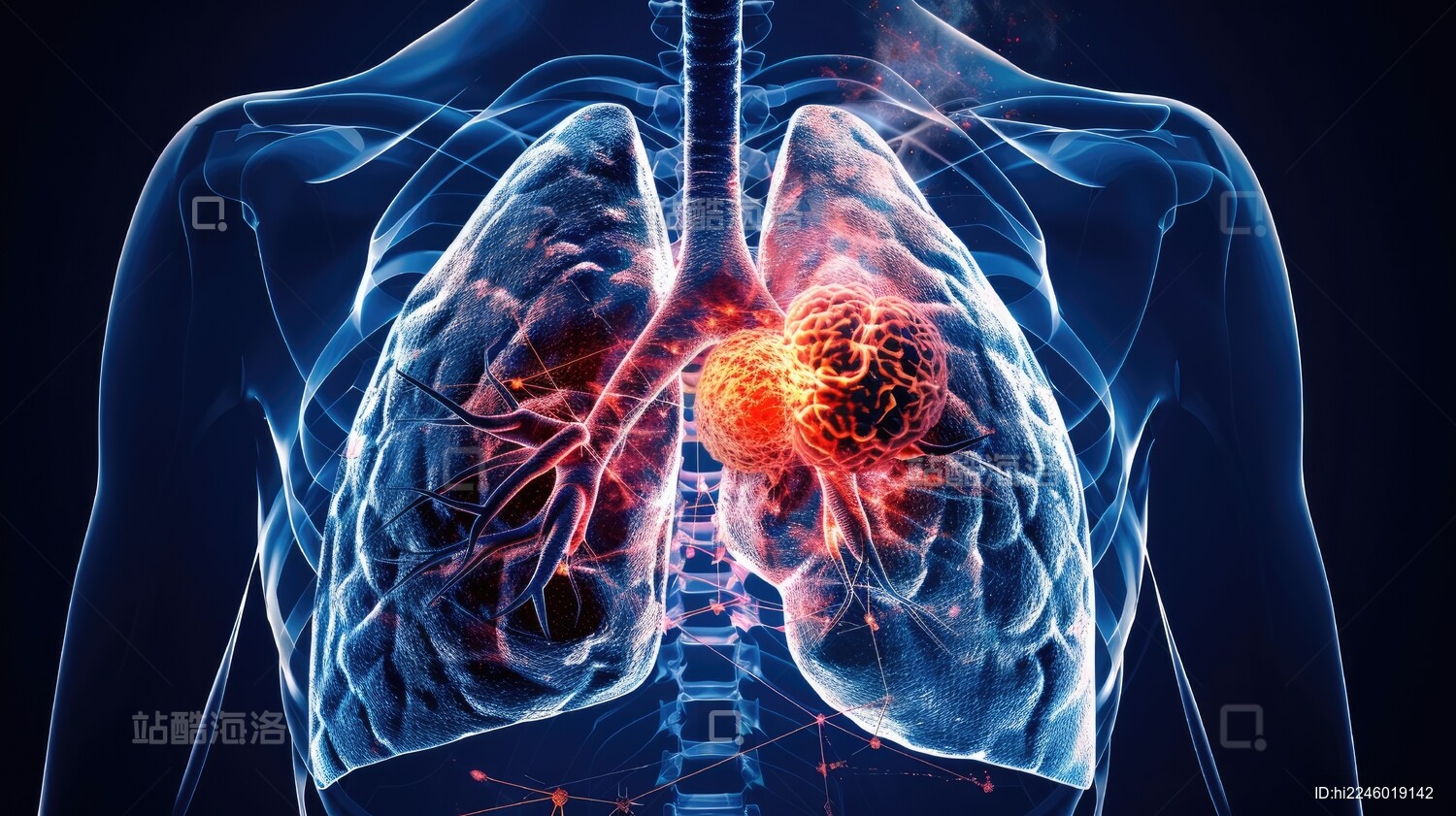 肺部肿瘤感染概念图