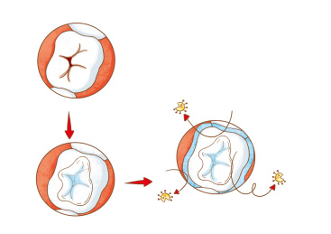龋坏的牙齿窝沟封闭对比