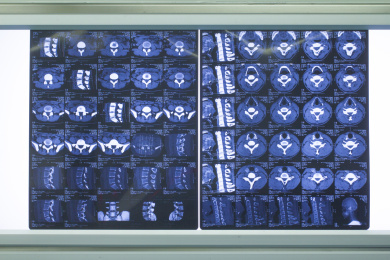 核磁共振医学影像胶片幻灯片