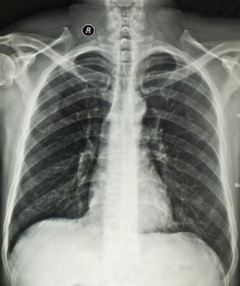 放射科医学影像胸部正位胶片