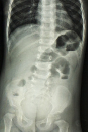 放射科医学影像腹部正位胶片肠梗阻
