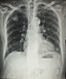 放射科医学X光影像胸部胶片