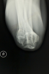 放射科医学X光影像肘关节胶片