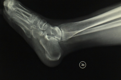 放射科医学X光影像踝关节胶片