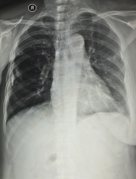 放射科医学影像胸部正位胶片