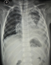 放射科医学X光影像胸部病变部位胶片
