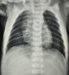 放射科医学X光影像胸部胶片