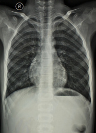 放射科医学影像胸部正位胶片