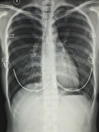 放射科医学X光影像胸部胶片