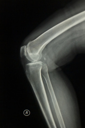 放射科医学X光影像肘关节胶片