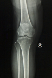 放射科医学X光影像肘关节胶片