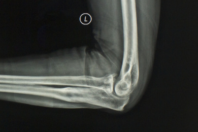 放射科医学X光影像肘关节胶片