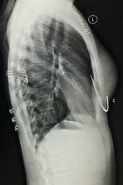 放射科医学X光影像胸部胶片
