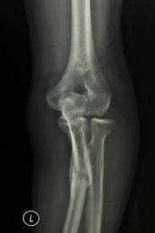 放射科医学X光影像肘关节胶片