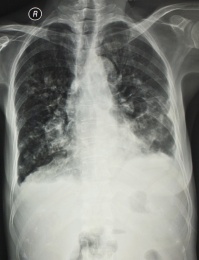 放射科医学X光影像胸部胶片