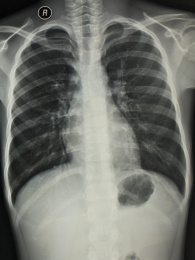 放射科医学影像胸部正位胶片